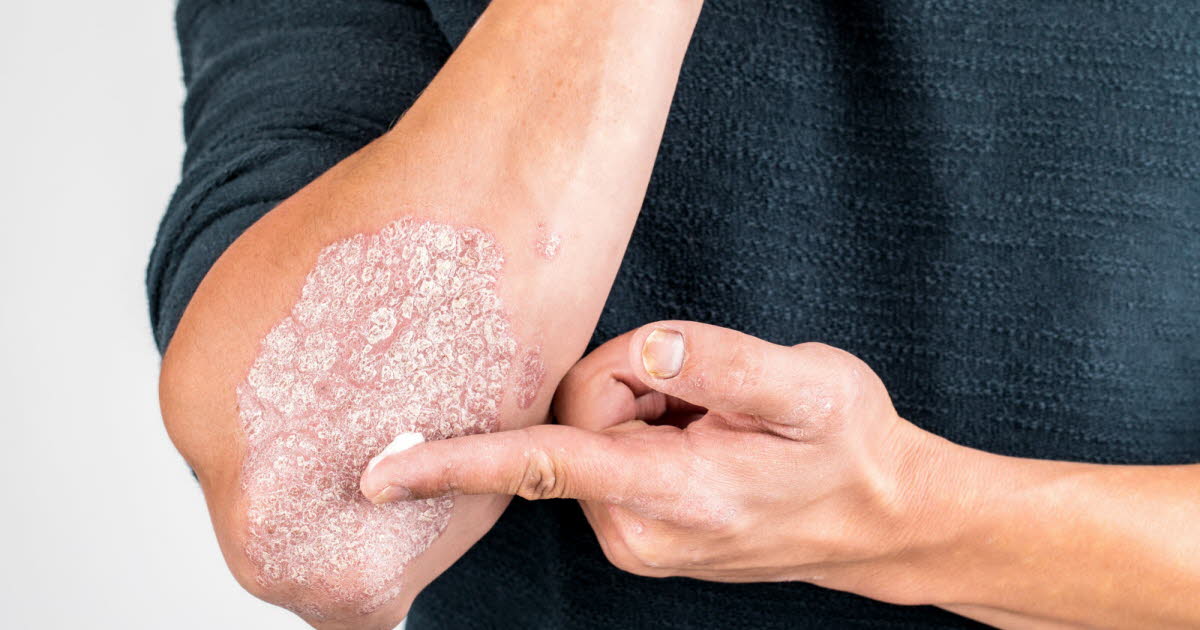 Psoriasis : une mutation génétique découverte, offrant l’espoir de nouveaux traitements