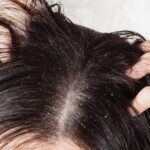Reconnaître et traiter les pellicules sèches et grasses : conseils dermatologiques