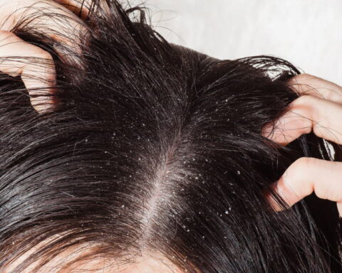 Reconnaître et traiter les pellicules sèches et grasses : conseils dermatologiques