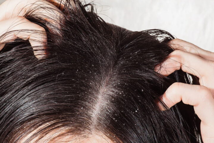 Reconnaître et traiter les pellicules sèches et grasses : conseils dermatologiques