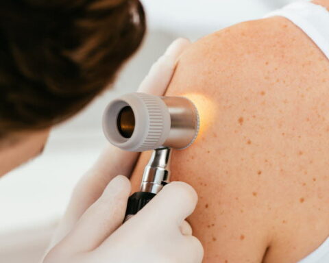 Un vaccin thérapeutique réduit le risque de récidive chez les patients atteints de mélanome
