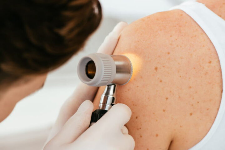 Un vaccin thérapeutique réduit le risque de récidive chez les patients atteints de mélanome