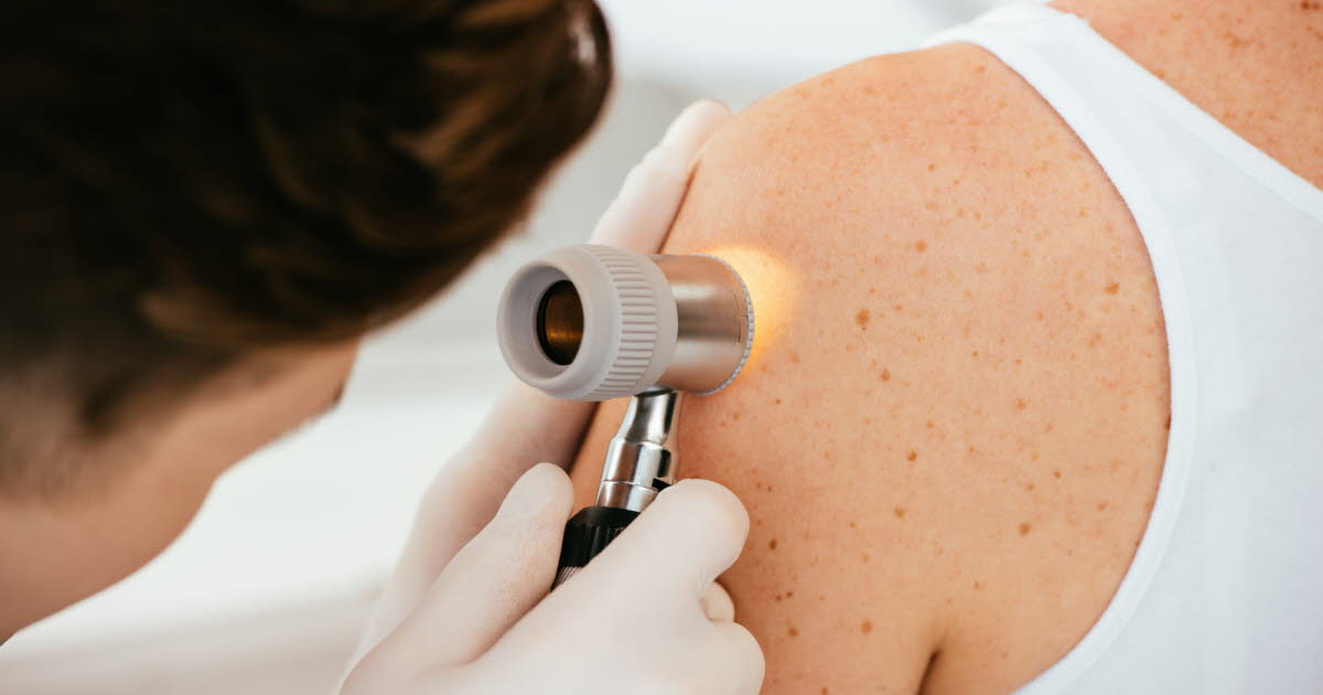 Un vaccin thérapeutique réduit le risque de récidive chez les patients atteints de mélanome