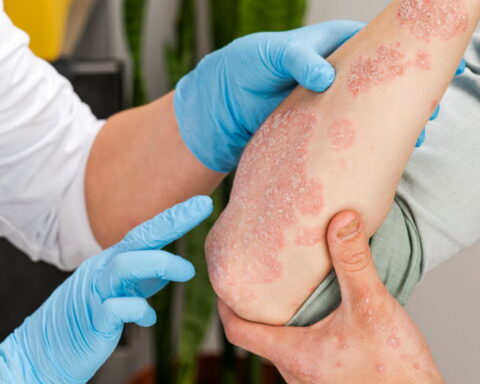 Psoriasis : la prise en charge améliore la qualité de vie des patients en France