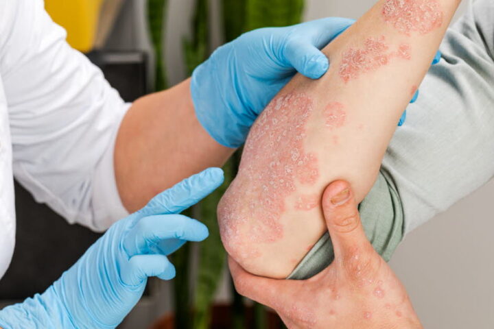 Psoriasis : la prise en charge améliore la qualité de vie des patients en France