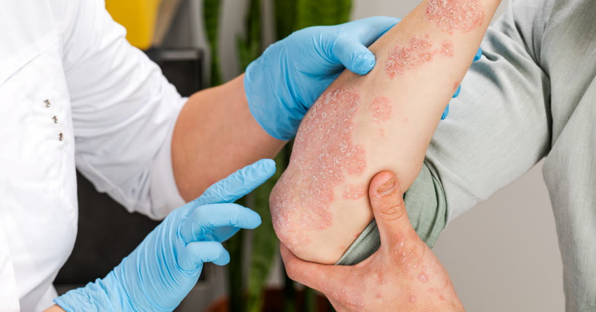 Psoriasis : la prise en charge améliore la qualité de vie des patients en France 1 Psoriasis : la prise en charge améliore la qualité de vie des patients en France