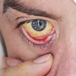 Un cancer sur huit dans le monde lié à des infections, révèle une étude du CIRC