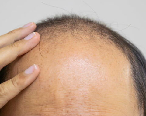 Un sucre naturel pourrait-il relancer la pousse des cheveux chez les chauves ?